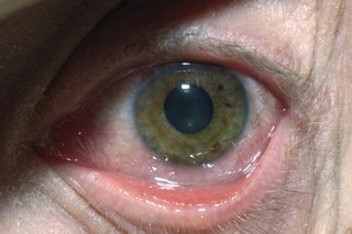 Infekcja oka opryszczka zwykła może powodować zaczerwienienie i obrzęk oka