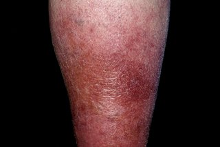 Cellulitis na podudziach