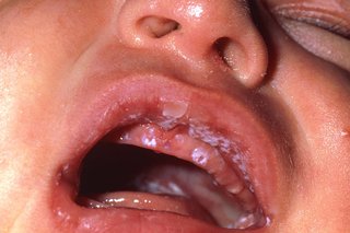 Białe plamy w ustach dziecka