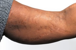 Ramię z obszarami rozciągniętej, błyszczącej skóry.