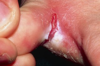 Pęknięta skóra między palcami spowodowana stopą sportowca