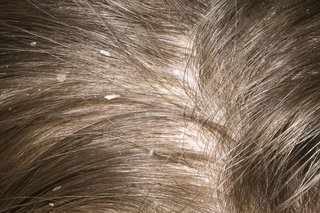 Zdjęcie płatków łupieżu na skórze głowy.