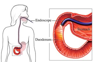 Schemat przedstawiający endoskopię