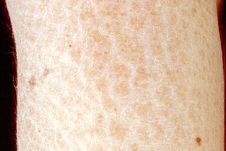 Zbliżenie ręki lub nogi osoby przedstawiające suchą, łuszczącą się skórę z rybią łuską.