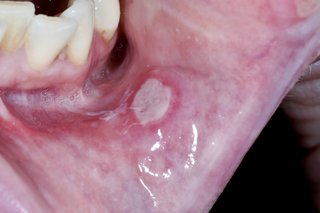 Pojedynczy owrzodzenie jamy ustnej po wewnętrznej stronie dolnej wargi