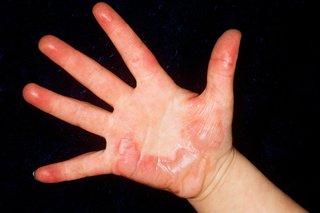 Zdjęcie oparzenia dłoni