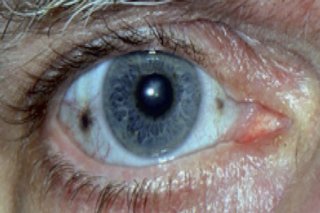 Oko dotknięte alkaptonurią, z dwoma brązowymi plamami na białku oka