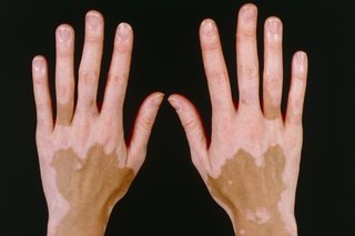 Obraz bielactwa niesegmentalnego na brązowej skórze