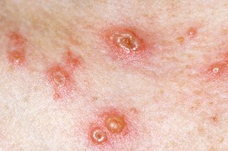 Małe czerwone plamki ze strupami w środku, na białej skórze.