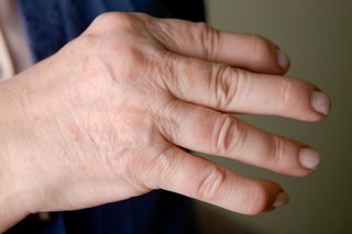 Na rysunku w zbliżeniu przedstawiono dłoń osoby z zapaleniem stawów w stawach palców