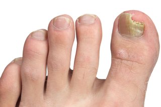 Złamany paznokieć spowodowany grzybicą paznokci.