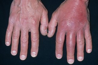 Opuchnięte dłonie spowodowane zapaleniem tkanki łącznej