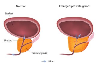 Schemat przedstawiający normalną prostatę i przerost prostaty.