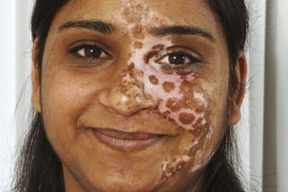 Zdjęcie kobiety z bielactwem odcinkowym na twarzy