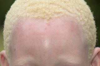 Afrykańska dziewczyna z albinizmem. Ma bladą skórę i krótkie, jasne blond włosy.