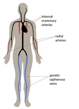 Ilustrowany diagram przedstawiający lokalizację tętnic piersiowych wewnętrznych w klatce piersiowej, tętnic promieniowych w przedramionach oraz żył odpiszczelowych większych w nogach