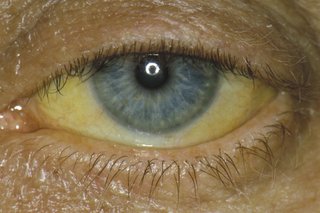 Zdjęcie przedstawiające żółte białka oka