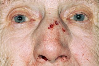 Starsza pani z rozcięciem na nosie i krwawieniem z nosa