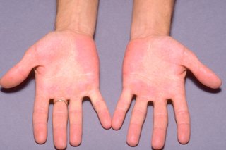 Czerwone plamy na dłoniach spowodowane erytromelalgią.