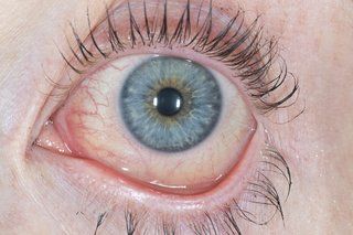 Czerwone i wodniste oko spowodowane zapaleniem spojówek