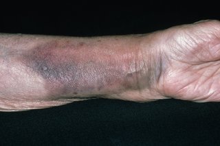 Zdjęcie złamanego nadgarstka