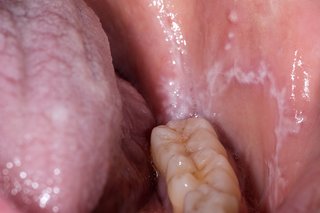 Otwarte usta, ukazujące dolny rząd zębów, z białymi plamami na języku i wewnątrz policzka