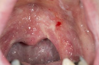 Czerwone plamy w jamie ustnej spowodowane pleśniawką