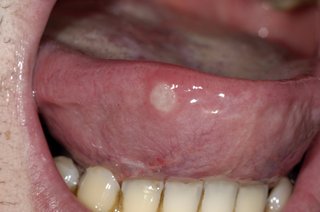 Biało-szary okrągły ból po stronie języka wystający z ust