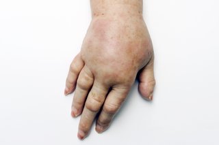 Rozciągnięta skóra dłoni i ramienia spowodowana obrzękiem