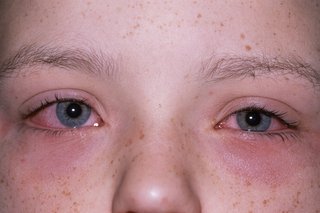 Obraz alergicznego zapalenia spojówek