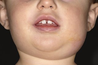 Dziecko z opuchniętą twarzą spowodowaną świnką.