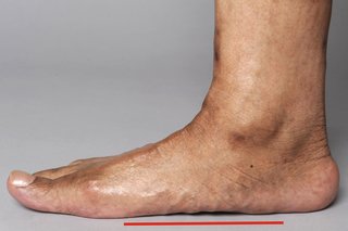 Prawa stopa mężczyzny płasko na ziemi. Nie ma przerwy między stopą a podłożem.