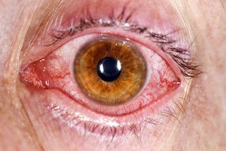 Zaczerwienione i ziarniste oko spowodowane zapaleniem spojówek