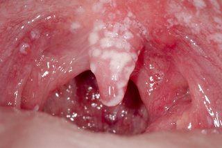 Białe plamy w jamie ustnej spowodowane pleśniawką