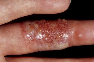Pęcherze na palcu spowodowane wirusem opryszczki