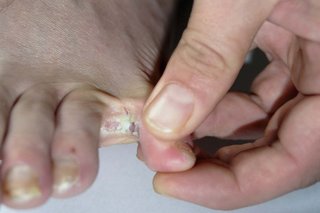 Biała plama między palcami spowodowana stopą sportowca